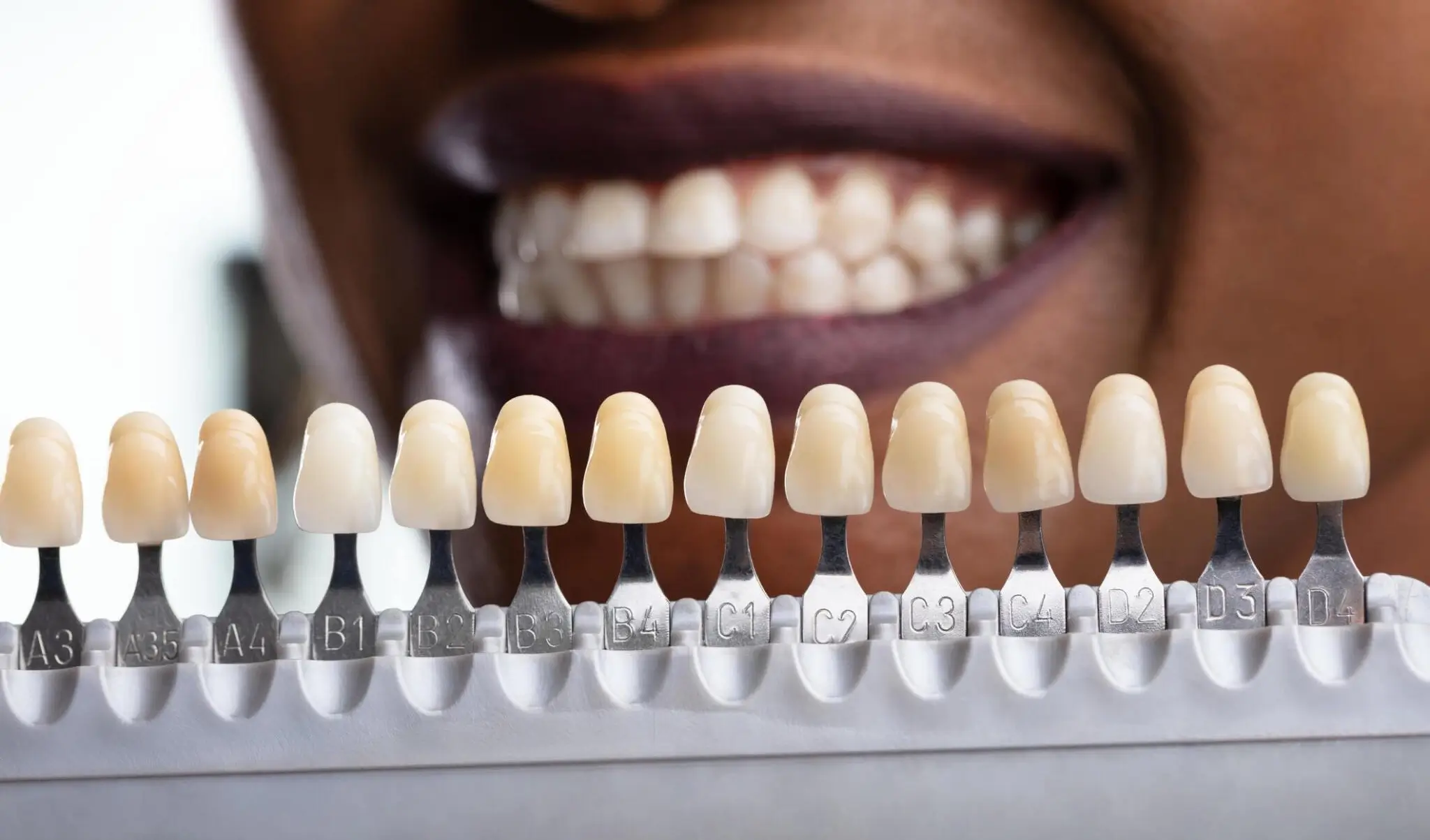 Dental Crowns and Bridges